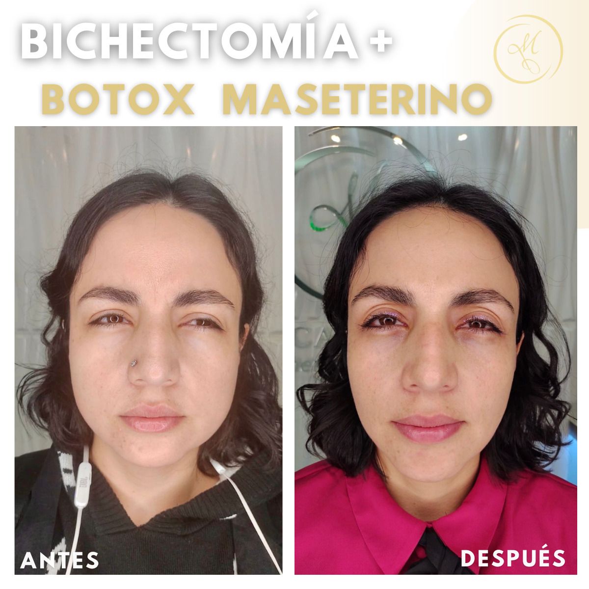 Bolas de Bichat Antes y después - Clinicasesteticas.cl