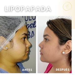 Lipopapada - Dra. Katherin Ruiz Márquez