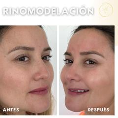 Rinomodelación - Dra. Katherin Ruiz Márquez