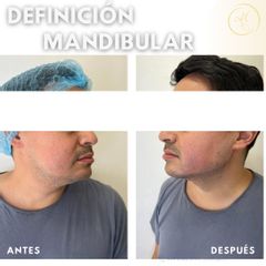 Definición mandibular - Dra. Katherin Ruiz Márquez