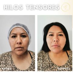 Hilos PDO (hilos tensores) - Dra. Katherin Ruiz Márquez