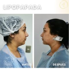 Lipopapada -  Dra. Katherin Ruiz Márquez