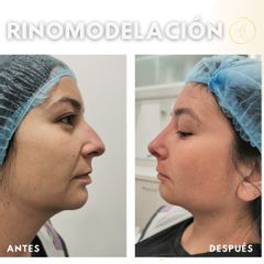 Rinomodelación  - Dra. Katherin Ruiz Márquez