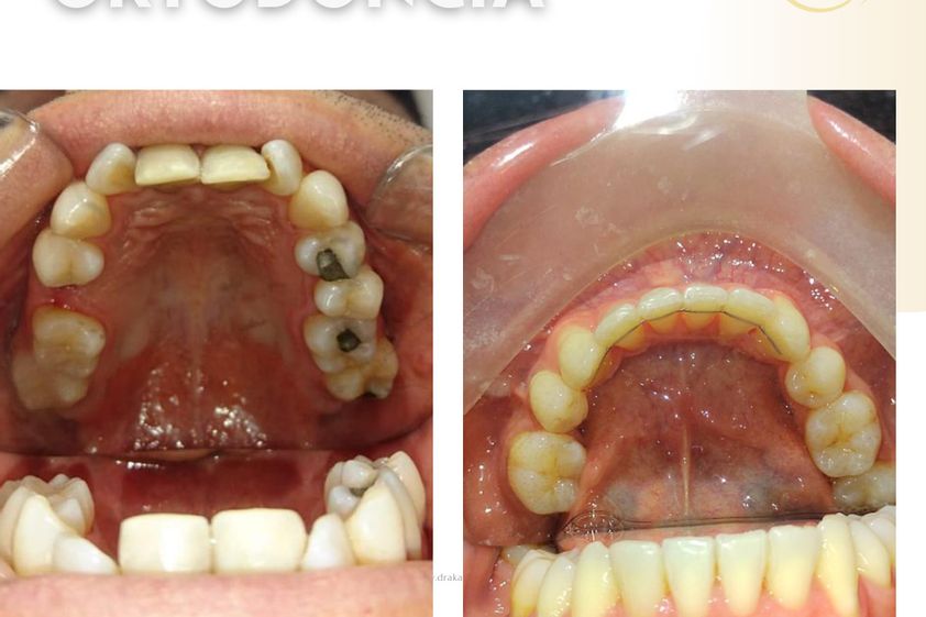 Brackets antes y después - 838226