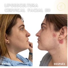 Lipoescultura cervical facial 8D - Dra. Katherin Ruiz Márquez