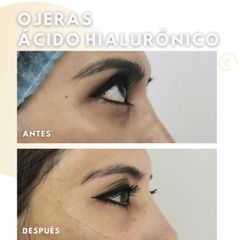 Tratamiento ojeras - Dra. Katherin Ruiz Márquez