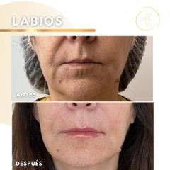 Aumento de labios - Dra. Katherin Ruiz Márquez