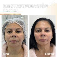 reestructuracion facial