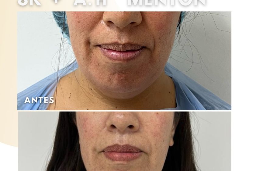 Mentoplastia antes y después - 852328
