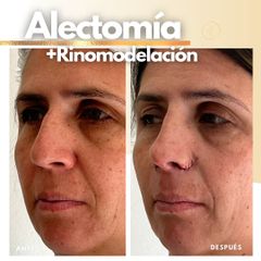 Alectomía + rinomodelación - Dra. Katherin Ruiz Márquez