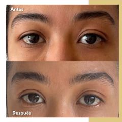 Lifting de Cejas - Dra. Katherin Ruiz Márquez