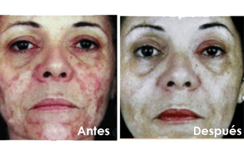 Peeling antes y después - 486782