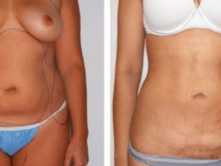 Antes y despues de lipoescultura