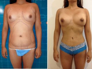 Antes y despues de lipoescultura