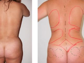 Antes y despues de lipoescultura