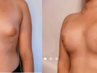 Antes y despues de implante mamario