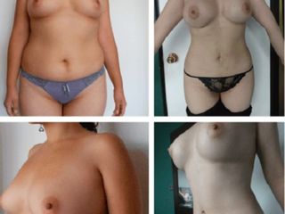 Antes y despues de lipoescultura