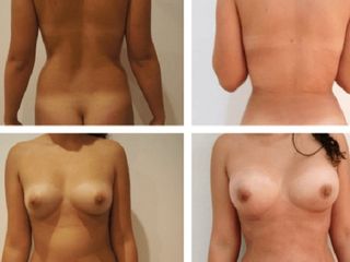 Antes y despues de lipoescultura