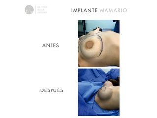 Implante mamario