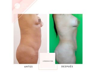 Liposucción
