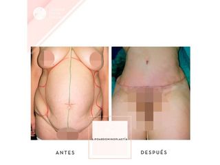 Abdominoplastia