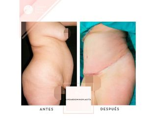 Abdominoplastia
