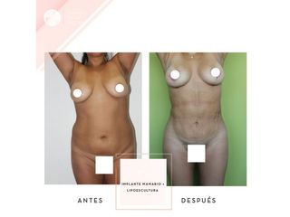 Clínica de la Figura - Implante mamario + Lipoescultura