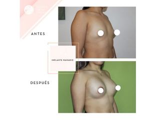 Clínica de la Figura - Implante mamario