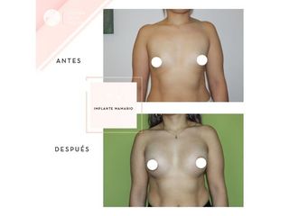 Clínica de la Figura - Implante mamario