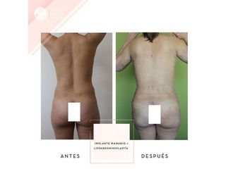 Clínica de la Figura - Implante mamario + Lipoabdominoplastia