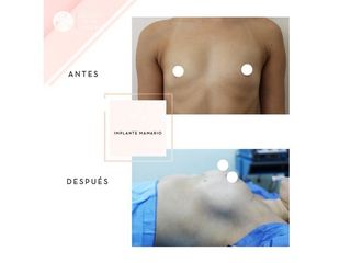 Clínica de la Figura - Implante mamario
