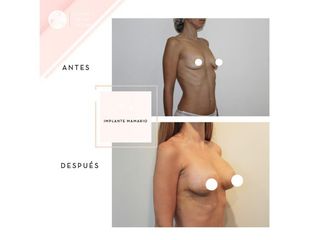 Clínica de la Figura - Implante mamario