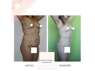 Clínica de la Figura - Implante mamario + Lipoescultura