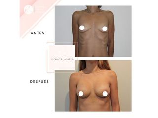 Clínica de la Figura - Implante mamario