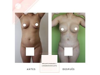 Clínica de la Figura - Implante mamario + Lipoabdominoplastia