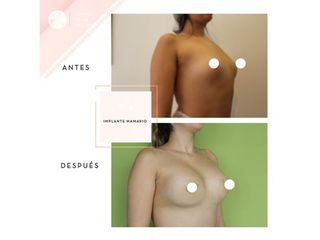 Clínica de la Figura - Implante mamario