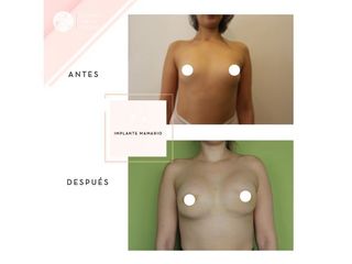 Clínica de la Figura - Implante mamario
