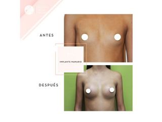Clínica de la Figura - Implante mamario