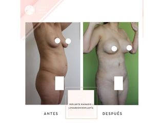 Clínica de la Figura - Implante mamario + Lipoabdominoplastia