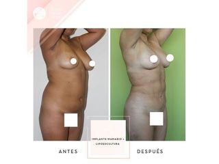 Clínica de la Figura - Implante mamario + Lipoescultura
