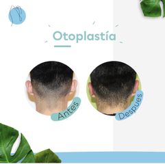 Otoplastía - Clínica de la Figura
