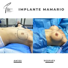 Aumento mamario - Clínica de la Figura