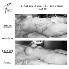 Lipoescultura - Clínica de la Figura