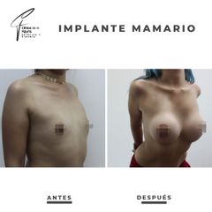 Aumento mamario - Clínica de la Figura