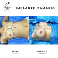 Aumento mamario - Clínica de la Figura