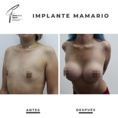 Aumento mamario - Clínica de la Figura