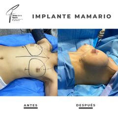 Aumento mamario - Clínica de la Figura