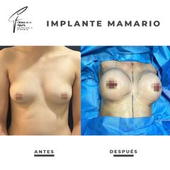 Aumento mamario - Clínica de la Figura