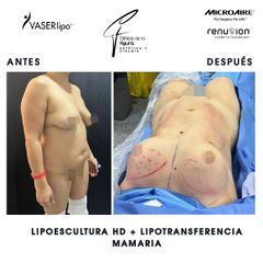 Lipoescultura - Clínica de la Figura