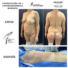 Lipoescultura - Clínica de la Figura